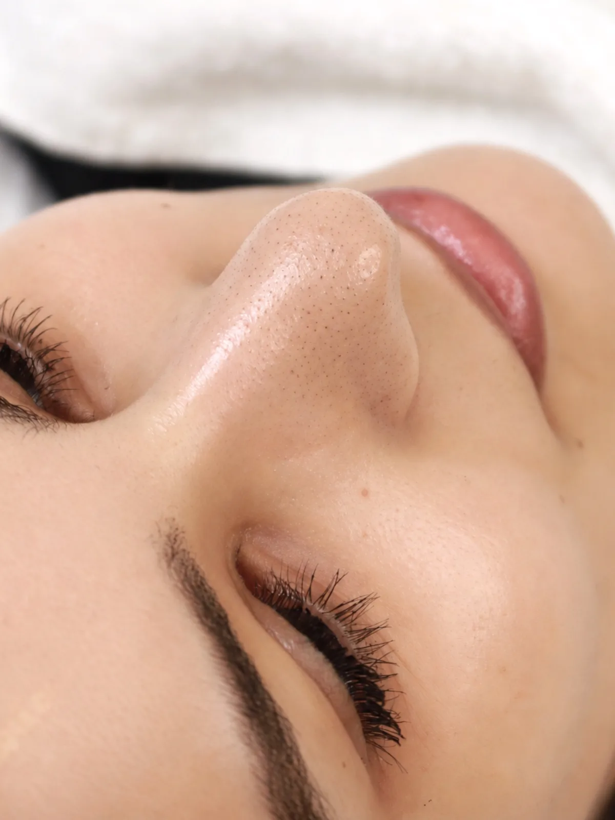Cleansing facial in Dubai, congested skin before treatment at AZIZAM beauty salon
